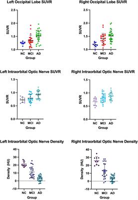 Computed Tomography Density and β-Amyloid Deposition of Intraorbital Optic Nerve May Assist in Diagnosing Mild Cognitive Impairment and Alzheimer’s Disease: A 18F-Flutemetamol Positron Emission Tomography/Computed Tomography Study